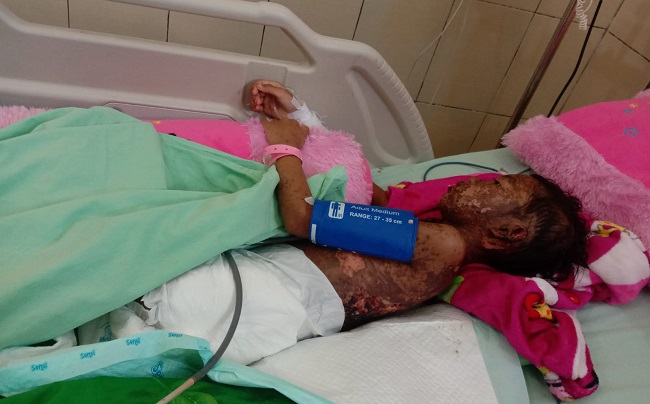 Mari Bantu Mila, Gadis dengan Luka Bakar di Seluruh Kulitnya